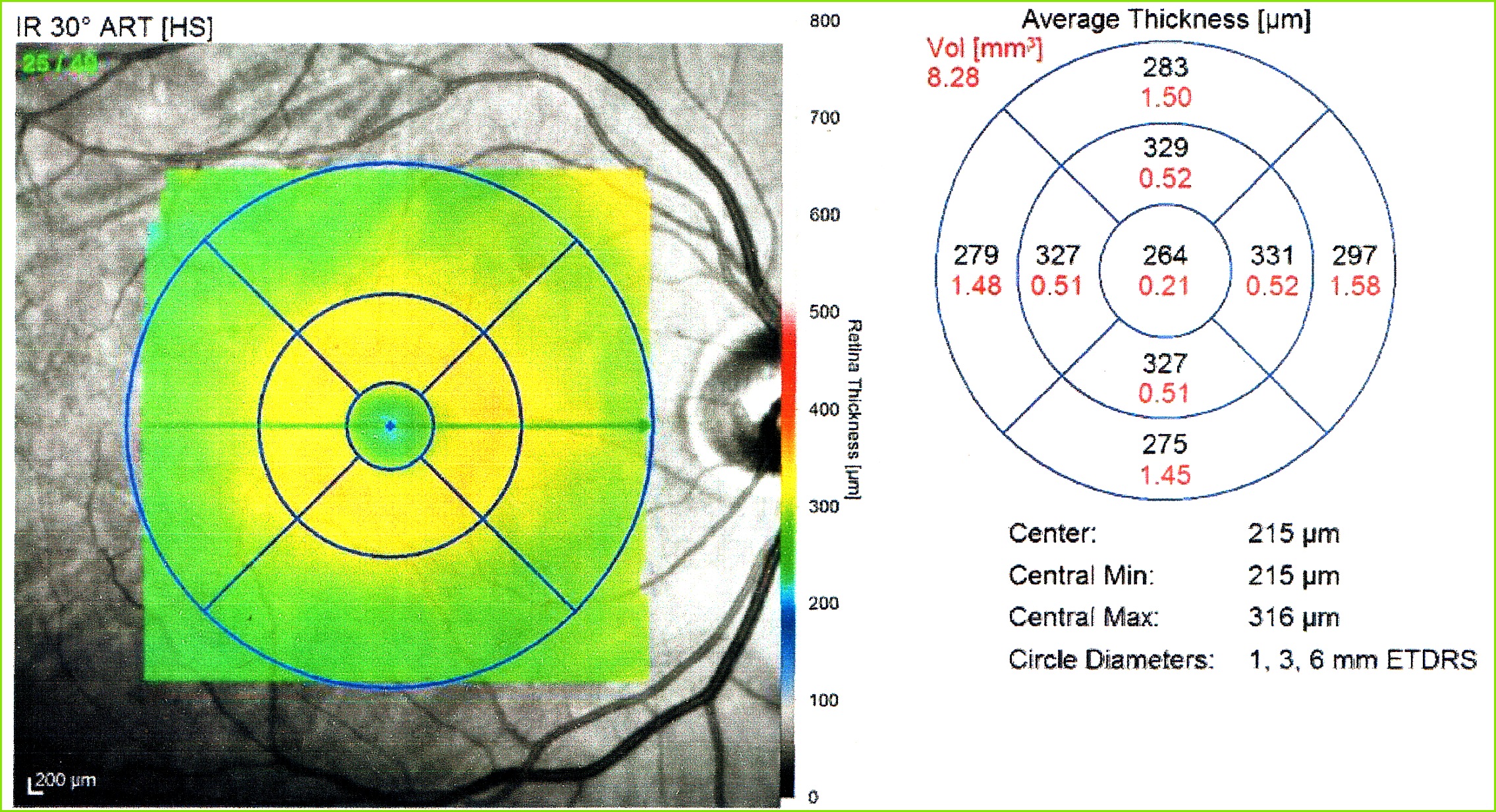 Ocular OCT retinal thickness map right eye